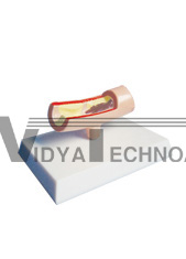 The model of thrombus